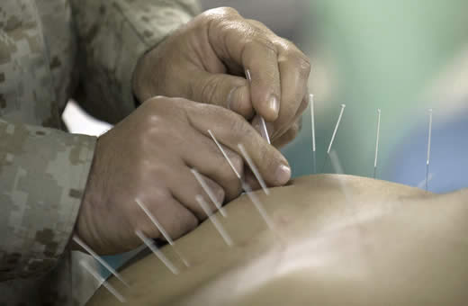 acupuncture treatment for weight loss